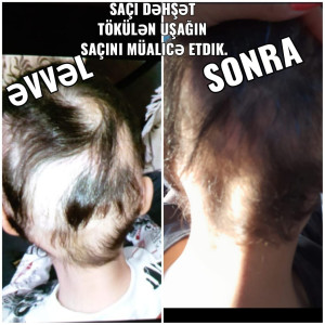 Hairloss Dandurff şampun